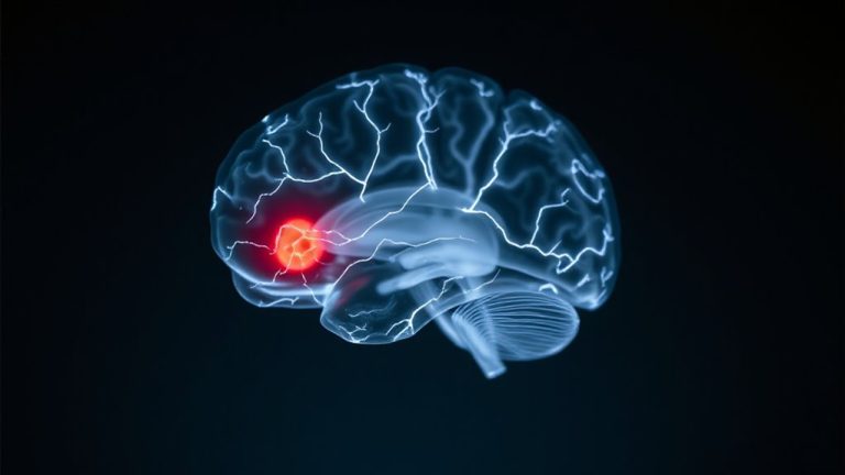brain lesions affect spindles